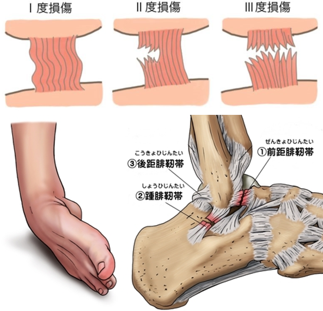 足関節捻挫について | セドナ整骨院・鍼灸院・カイロプラクティック