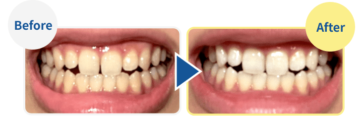 ホワイトニングについて ｜ RIMOBI（リモビ）｜オンライン診療で簡単