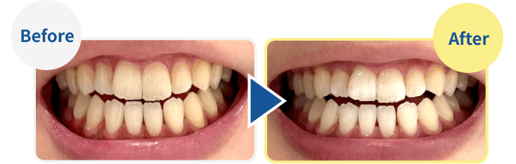 RIMOBI（リモビ）｜オンライン診療で簡単！ホワイトニング