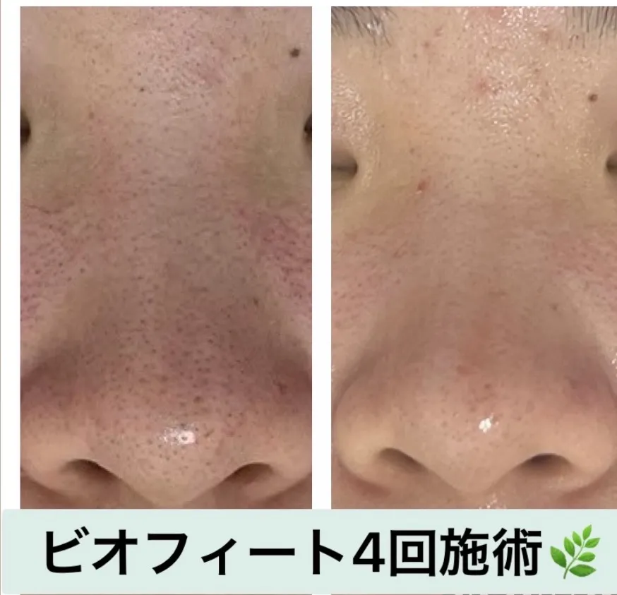 毛穴ひらき、黒ずみ毛穴（いちご鼻）などの毛穴汚れを綺麗にしたい方は