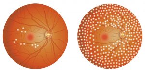 糖尿病網膜症 | さいたま新都心眼科