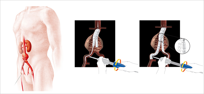 ステントグラフトによる治療について ｜ 大動脈瘤・解離の専門医｜川崎