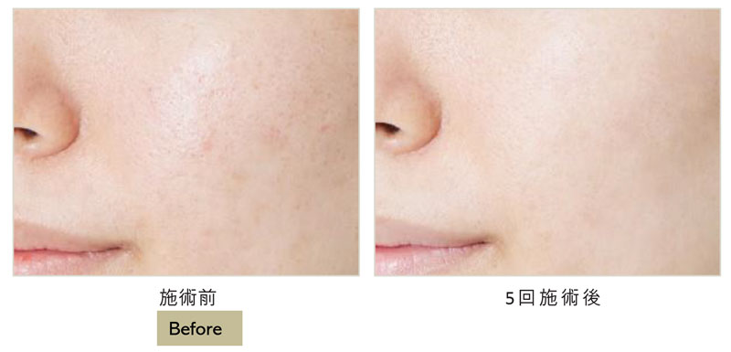 エクソヒーラー「フィルコアSB」｜南越谷病院 皮膚科・美容皮膚科