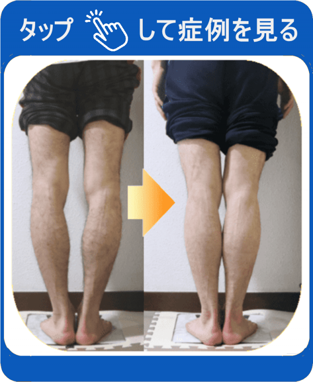 O脚矯正 | 新宿・笹塚のO脚、骨盤矯正「めぐみ整骨院」