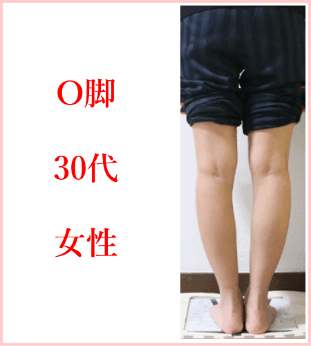 O脚矯正 | 新宿・笹塚のO脚、骨盤矯正「めぐみ整骨院」