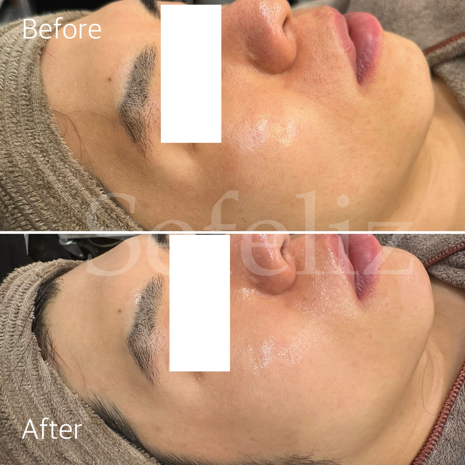 ワイコ水光ピール効果写真紹介！たった1回で想像以上の透明感