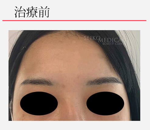 コブダイ」にならない額（おでこ）ヒアルロン酸注入のモニターさん症例