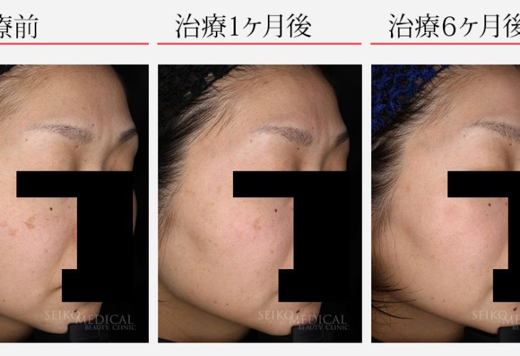 1ヶ月 | ゼオスキンヘルス｜セイコメディカルビューティクリニック
