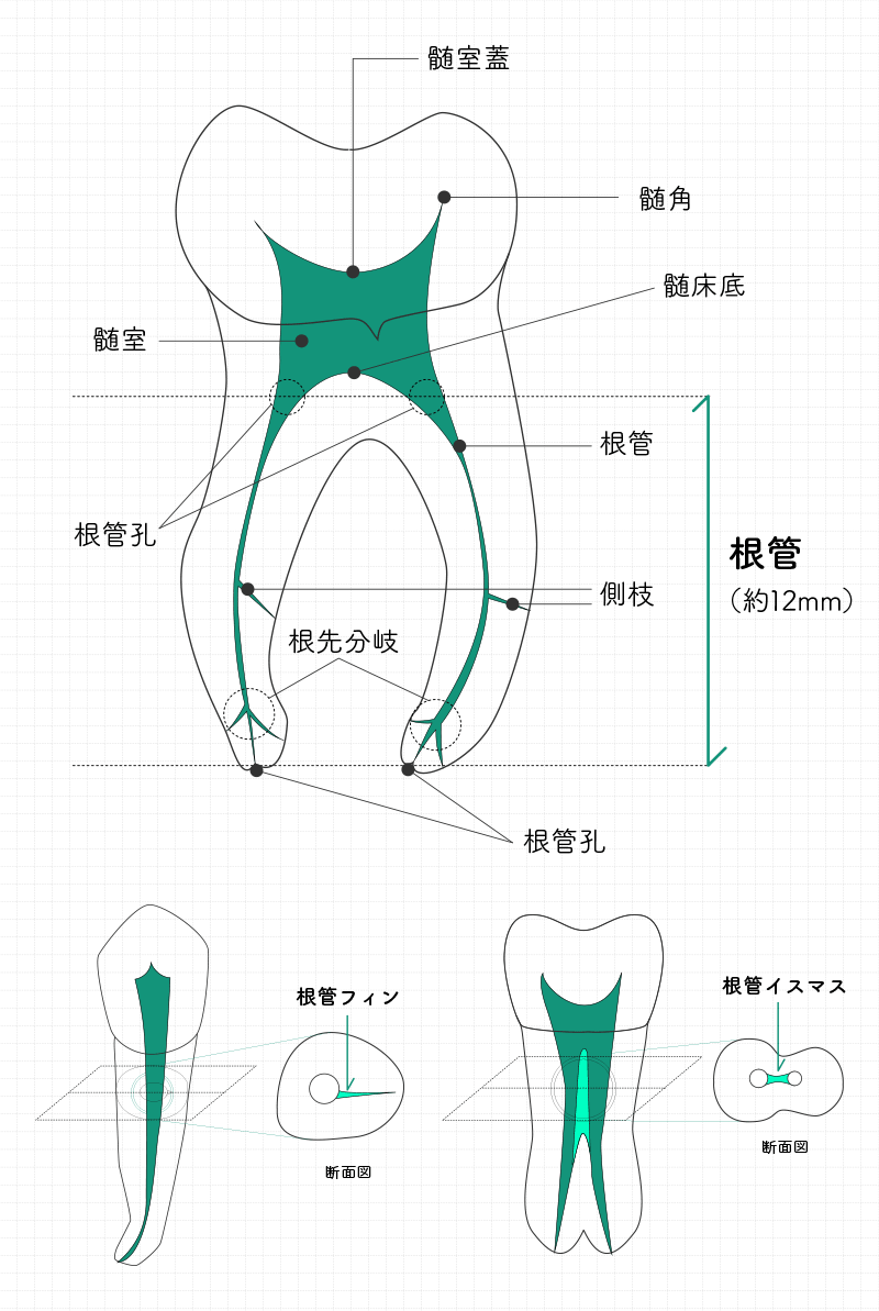 根管治療(歯内療法)の 成功率が低い理由