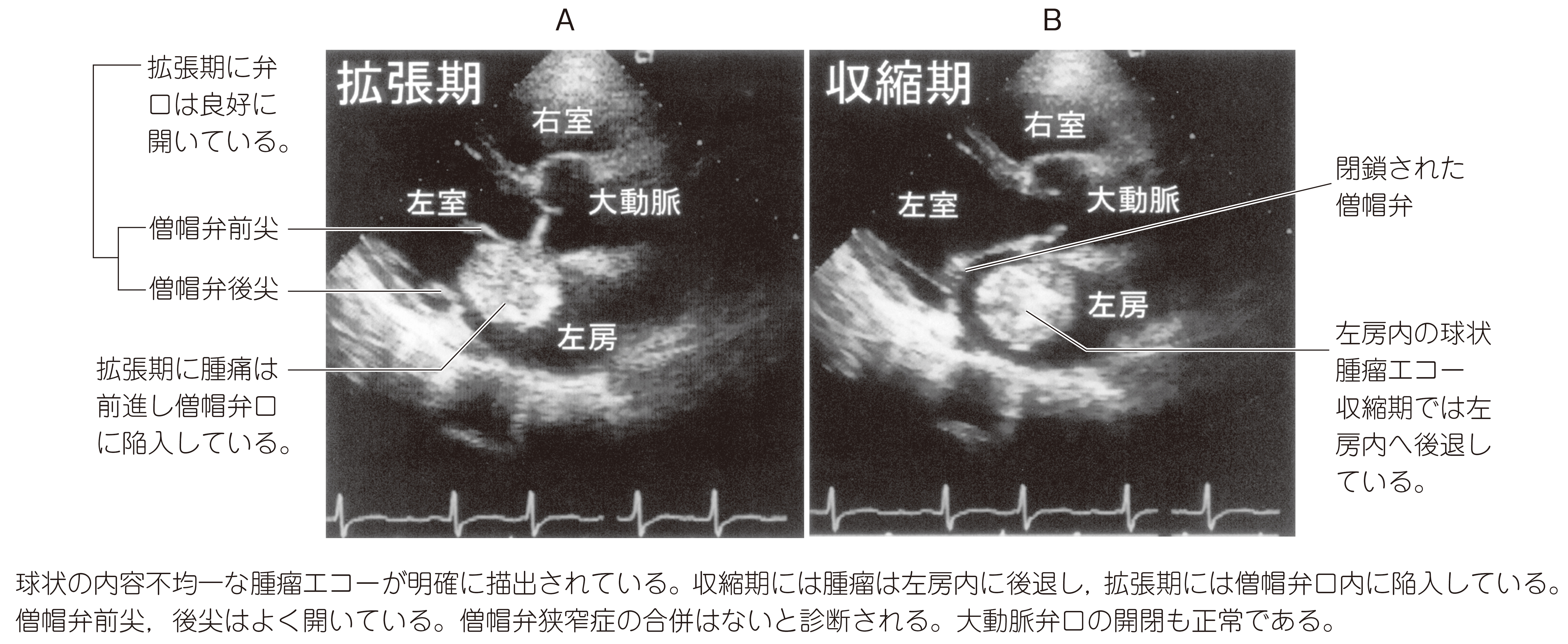 94F10 | 心臓腫瘍 国試 | テコプラ