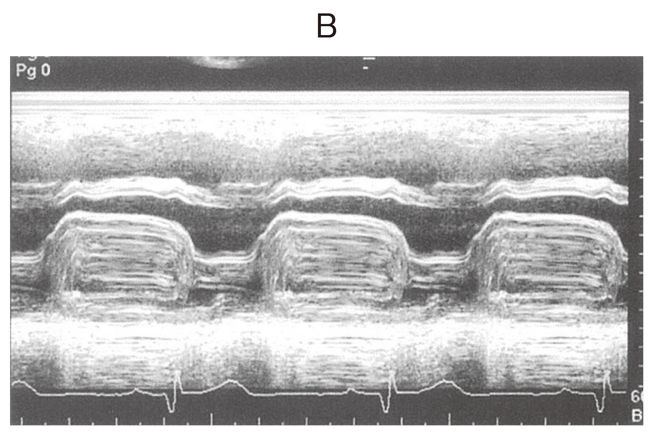 98B13 | 心臓腫瘍 国試 | テコプラ