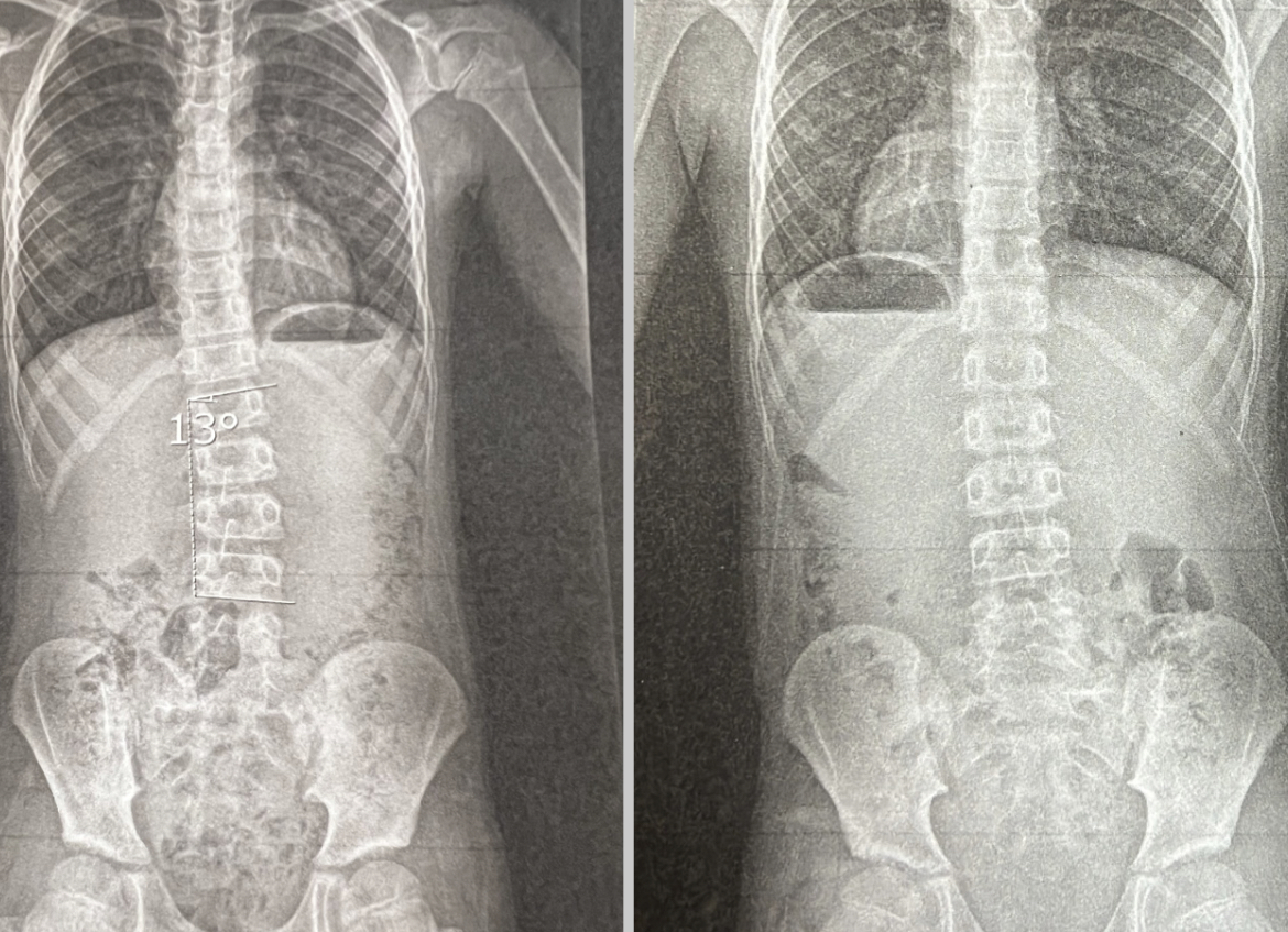 側弯症が完治に至るまで実施した運動を3つご紹介 | 浜松の鍼灸院 た