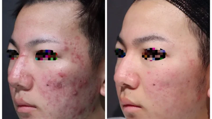 │シェリークリニック｜ニキビ治療に関するコラム