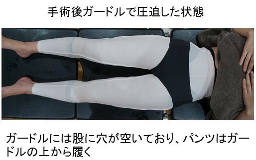脂肪吸引後の圧迫は必要？矯正下着の写真とその期間とは