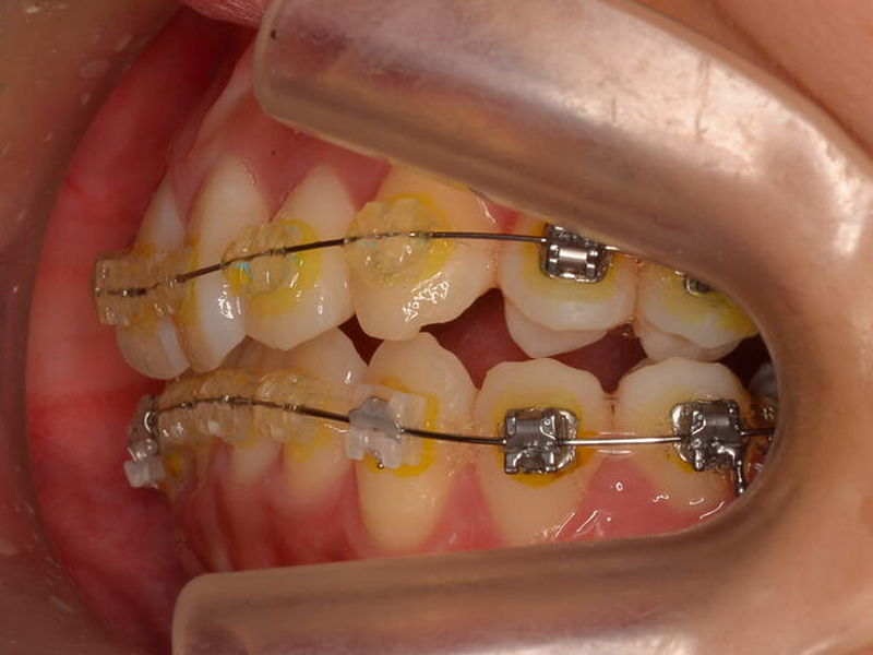 矯正の症例紹介 17歳高校生（治療期間2年0か月）｜MARIMO NOTE｜逗子の