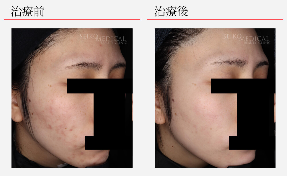 ゼオスキンヘルス 症例写真 | ニキビ治療の実績多数｜セイコメディカル