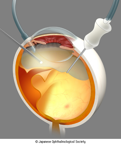 網膜硝子体手術 | 【すみれ眼科】日帰り白内障・硝子体手術