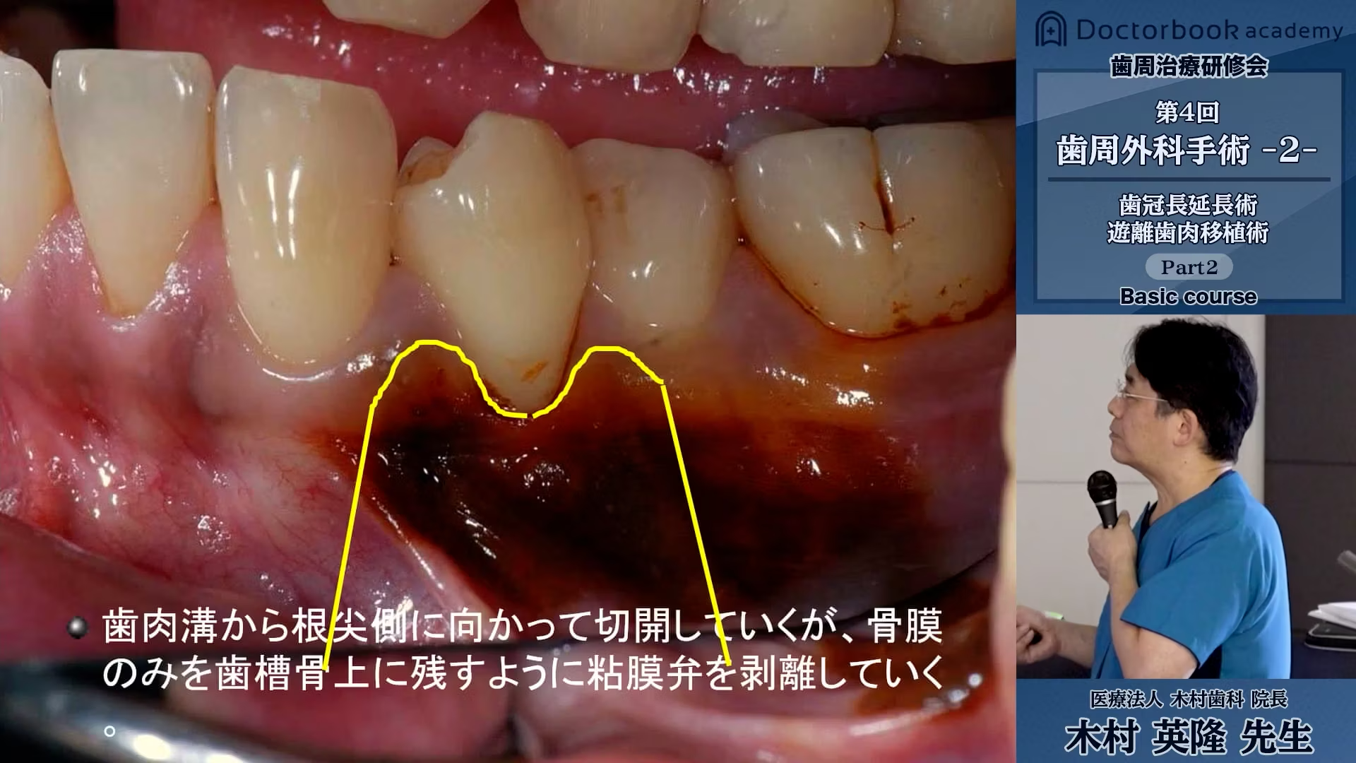 FGGとCTGの違いと適応症│遊離歯肉移植術のメリット・デメリット【歯科