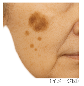 シミ・くすみ #1】間違うと逆効果？まずは見分けたいシミの種類