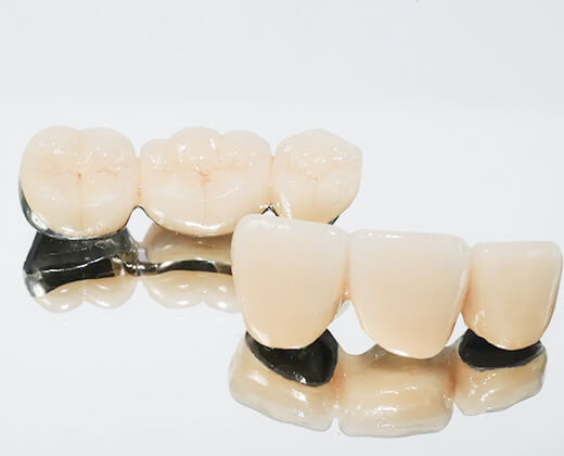 メタルボンド | 東京の自費技工専門歯科技工所 | ケン・デンタリックス