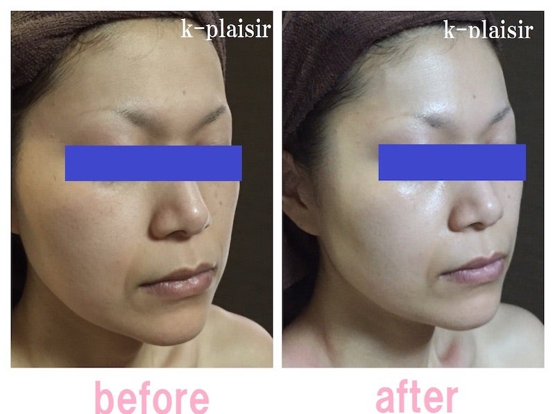 ハイドラフェイシャルとハイドロインパクト | 大阪市本町 美肌