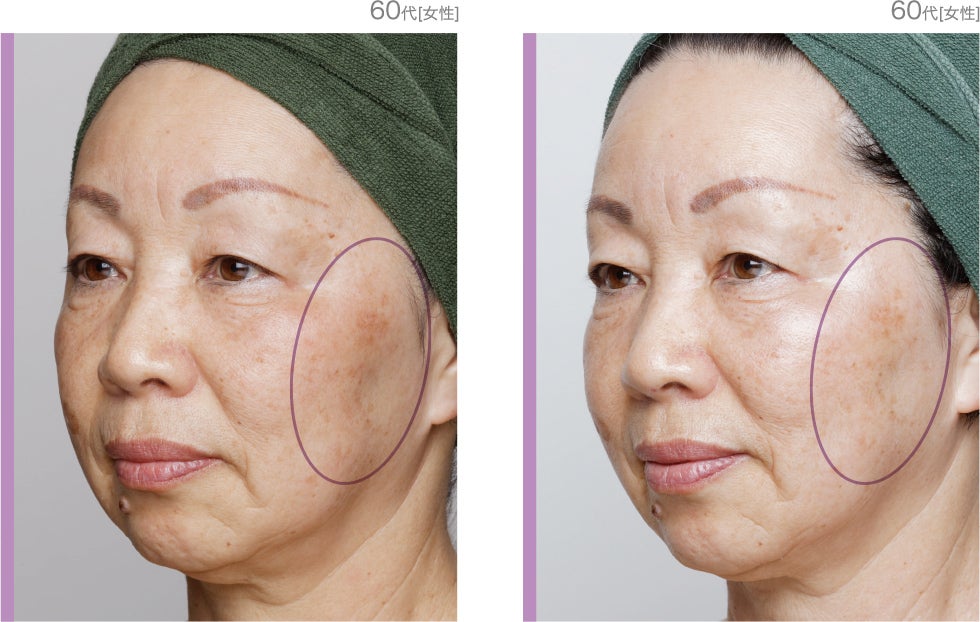 Facial》ダーマスクライバー毛穴洗浄ケア 美しさの基本は洗うこと