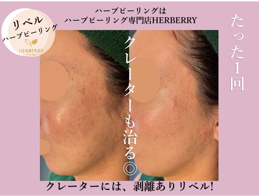 リベルハーブピーリング◇クレーター肌も変わります！ | ハーブ