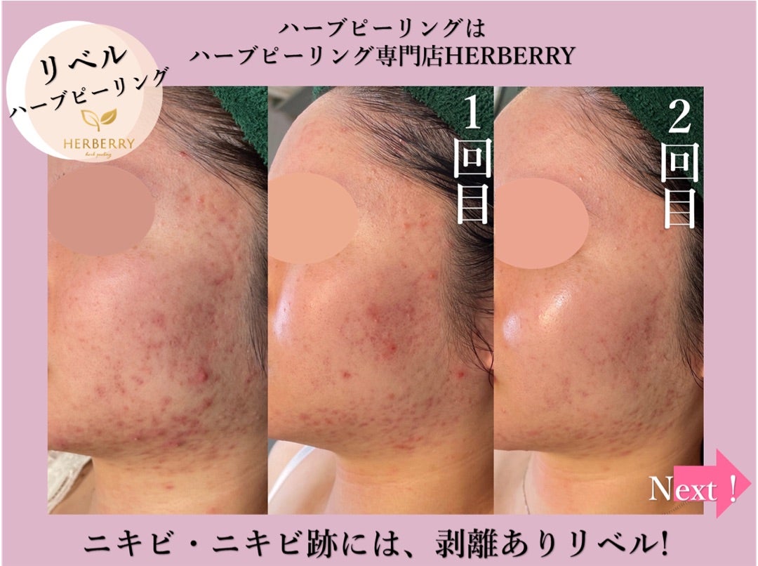 リベルハーブピーリング◇たった2回でこの効果！！ | ハーブピーリング