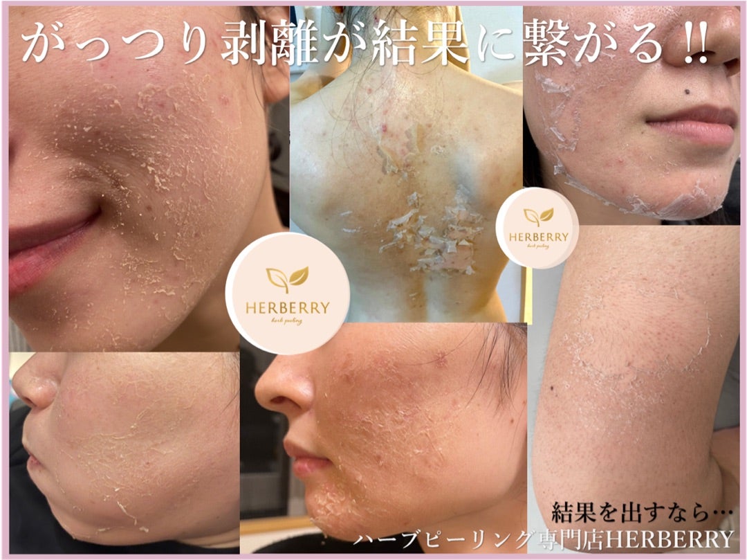最強リベルハーブピーリング◇即効性◎美白効果も◎ | ハーブ