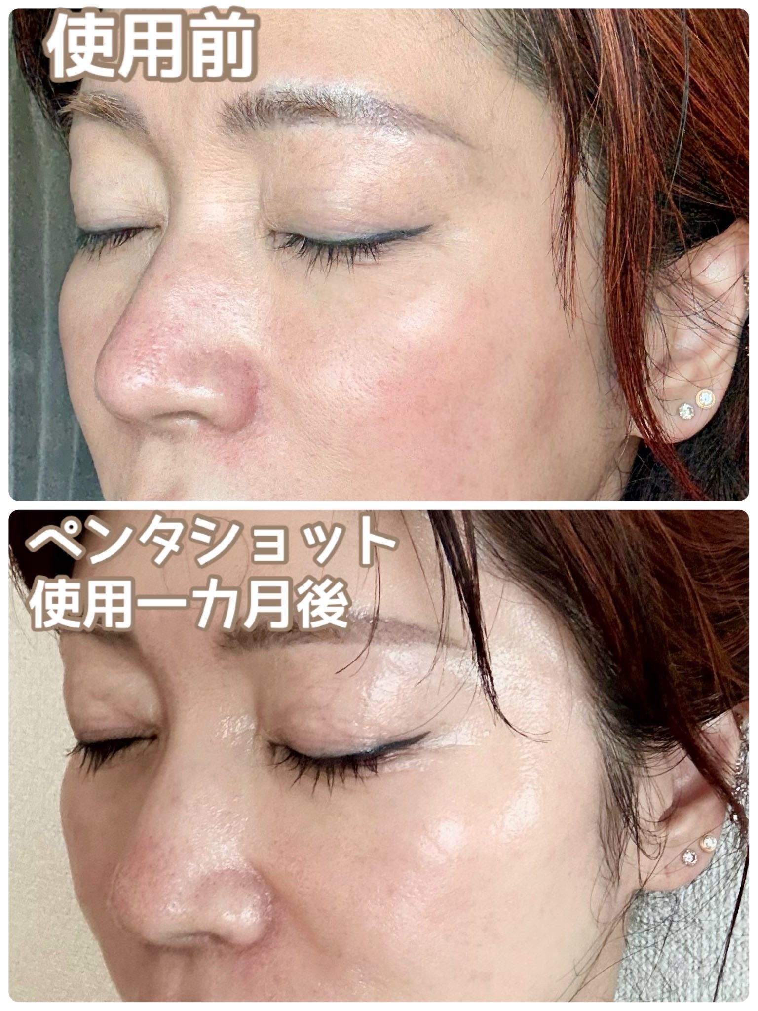 セロラバイ ペンタショット 角質除去 韓国美容 美顔器 毛穴 毛穴ケア