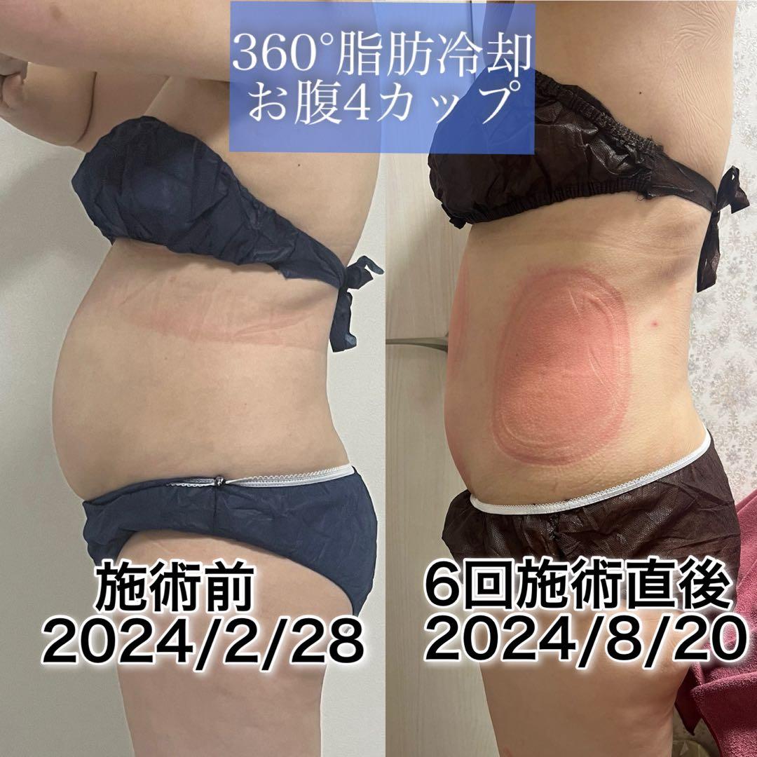 100枚セット Lサイズ 脂肪冷却シート 保護シート 不凍シート高品質厚手