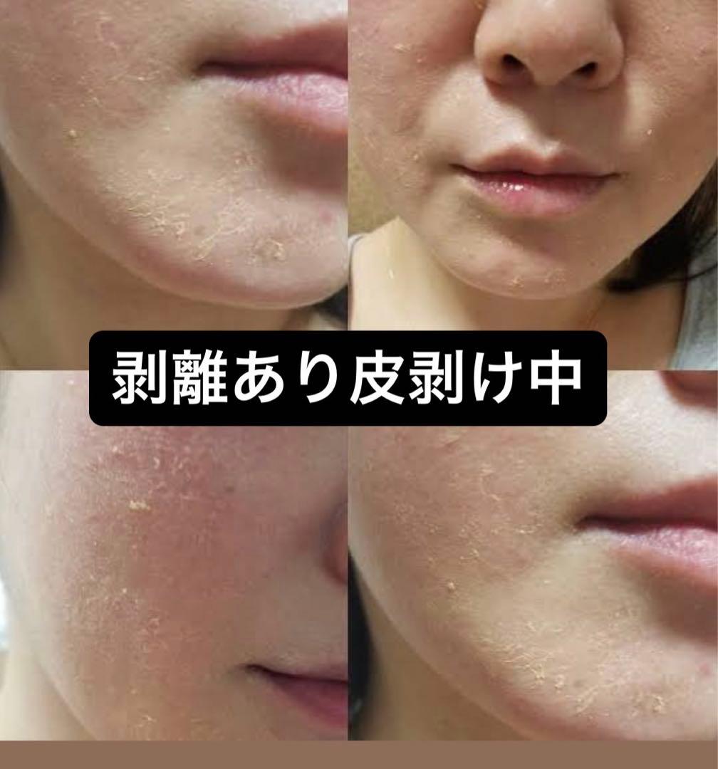 ハーブピーリング 剥離あり 皮剥けあり 8-9回分→9g - メルカリ