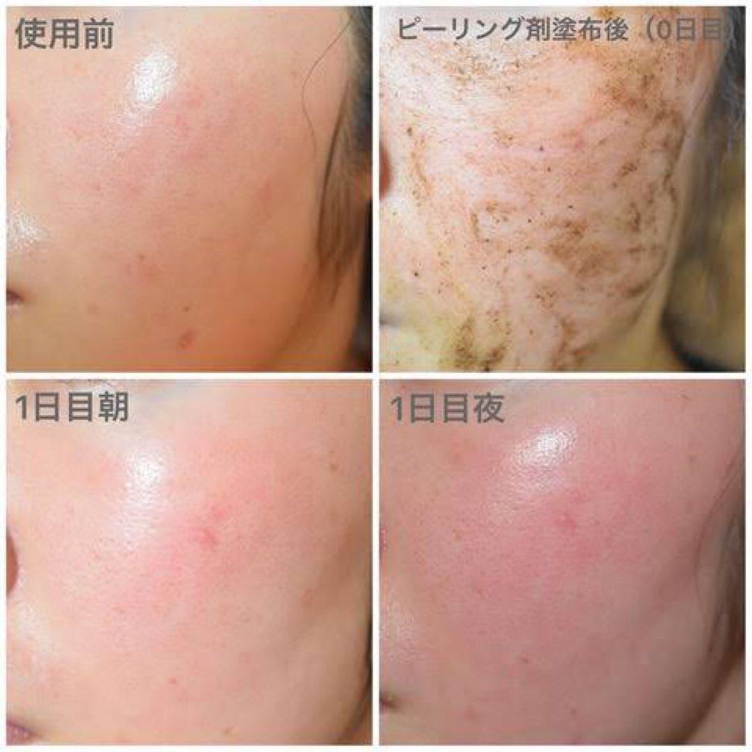 ハーブピーリング 剥離あり 皮剥けあり 8-9回分→9g - メルカリ