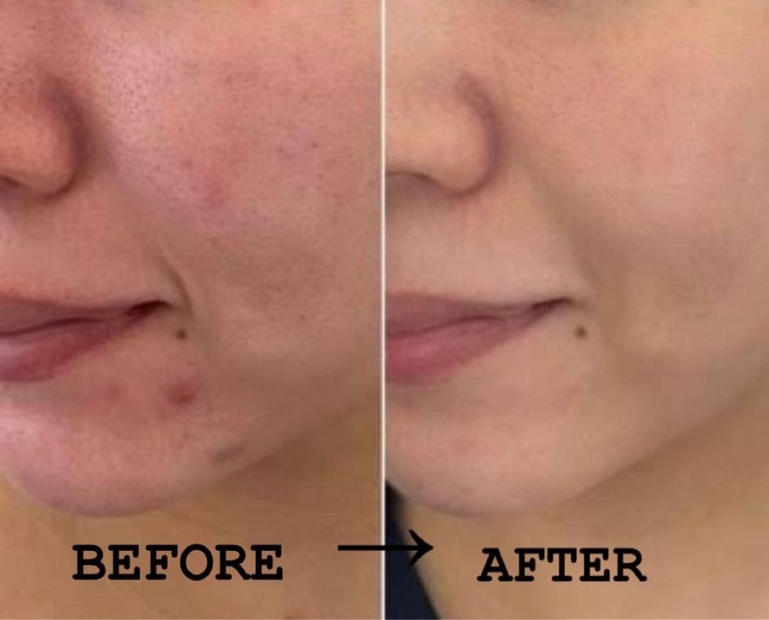 ハーブピーリング 剥離あり 皮剥けあり 8-9回分→9g - メルカリ