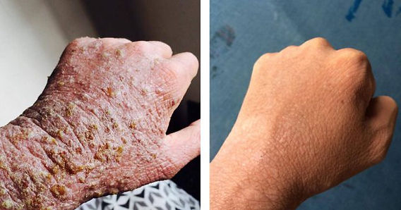 アトピーが劇的に治ったアーユルヴェーダの病院！！